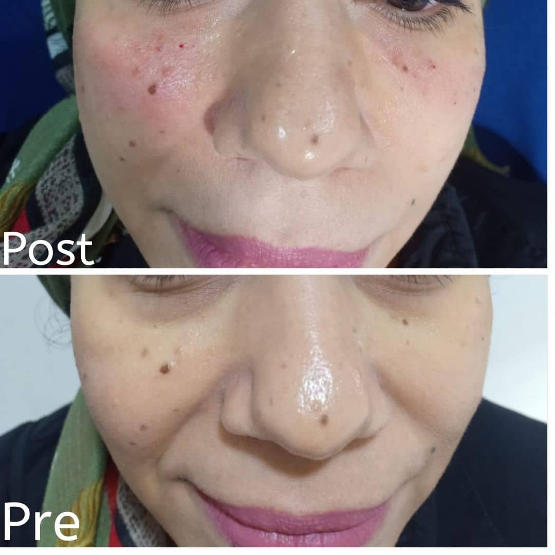 فيلر للوجه وتحت العينين في الغردقة